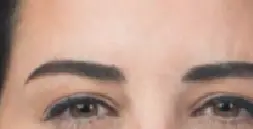 NEUROMODULATION BOTOX 2 after
