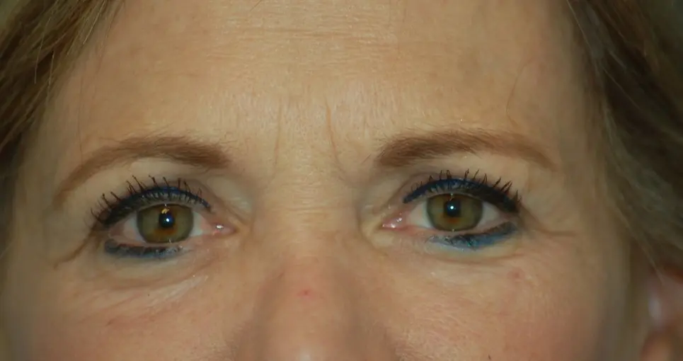 Lower eyelids and laser-before