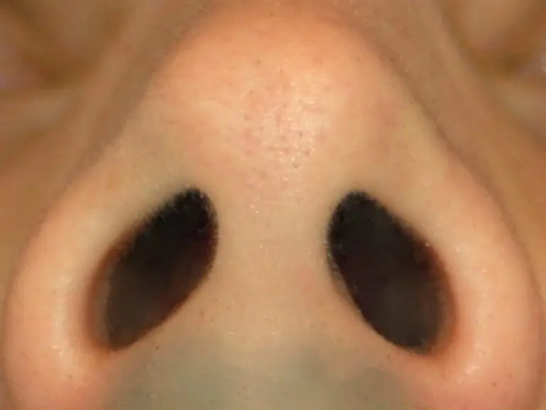 septoplasty Barrington, IL