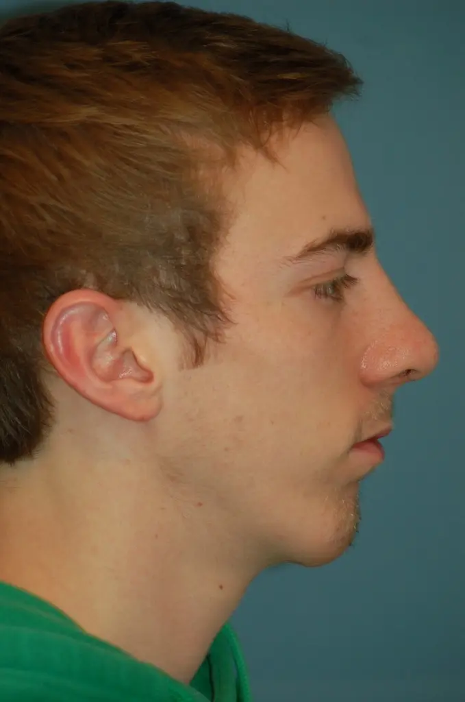 Open rhinoplasty- after