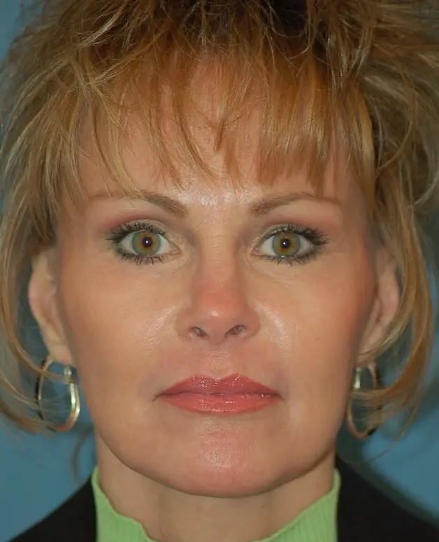 Endoscopic brow lift-after