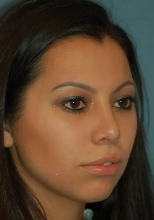 Open cleft rhinoplasty and lip scar revision-after