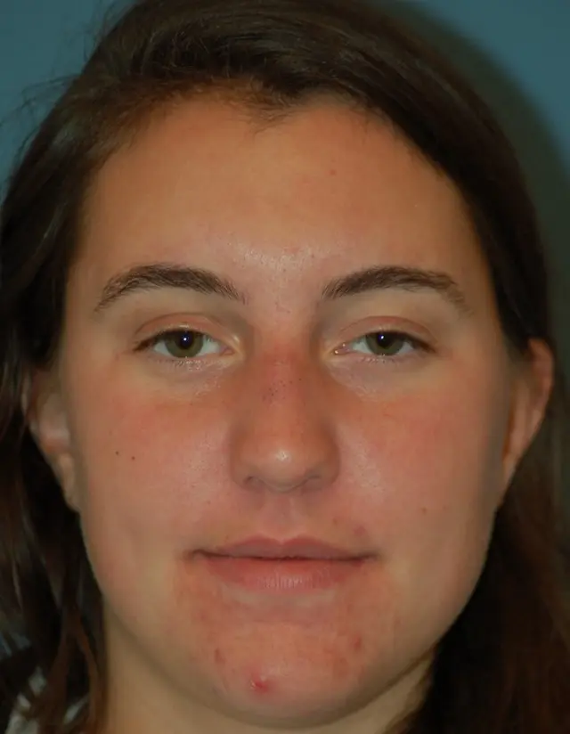 Open rhinoplasty -before