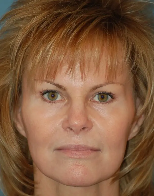 Endoscopic brow lift-before