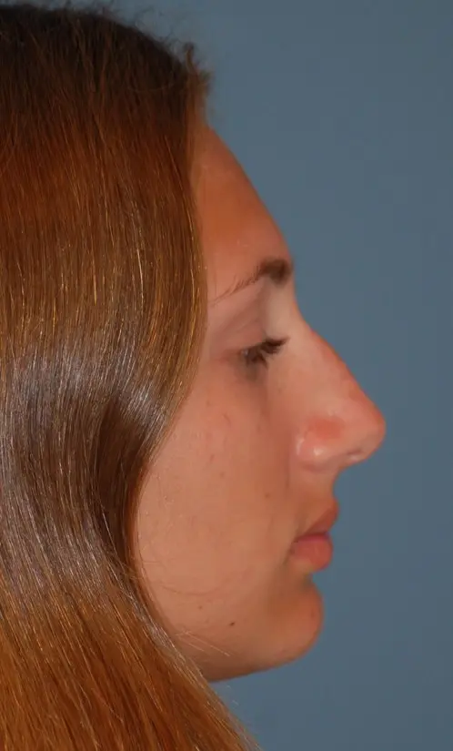 Open rhinoplasty-before