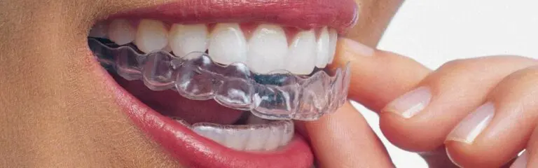 Close-up of Invisalign tray being placed on upper teeth.