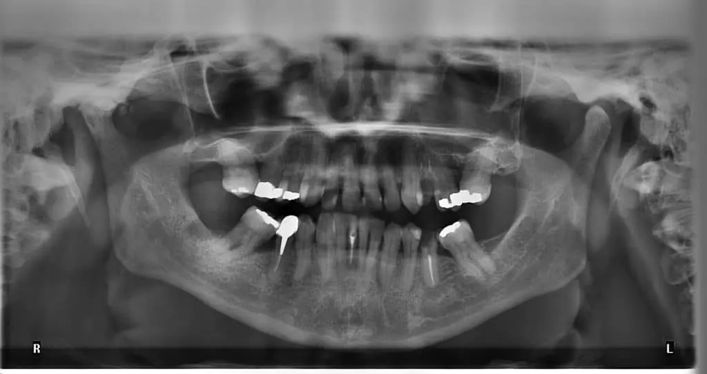 tooth fillings 2 1024x542 1