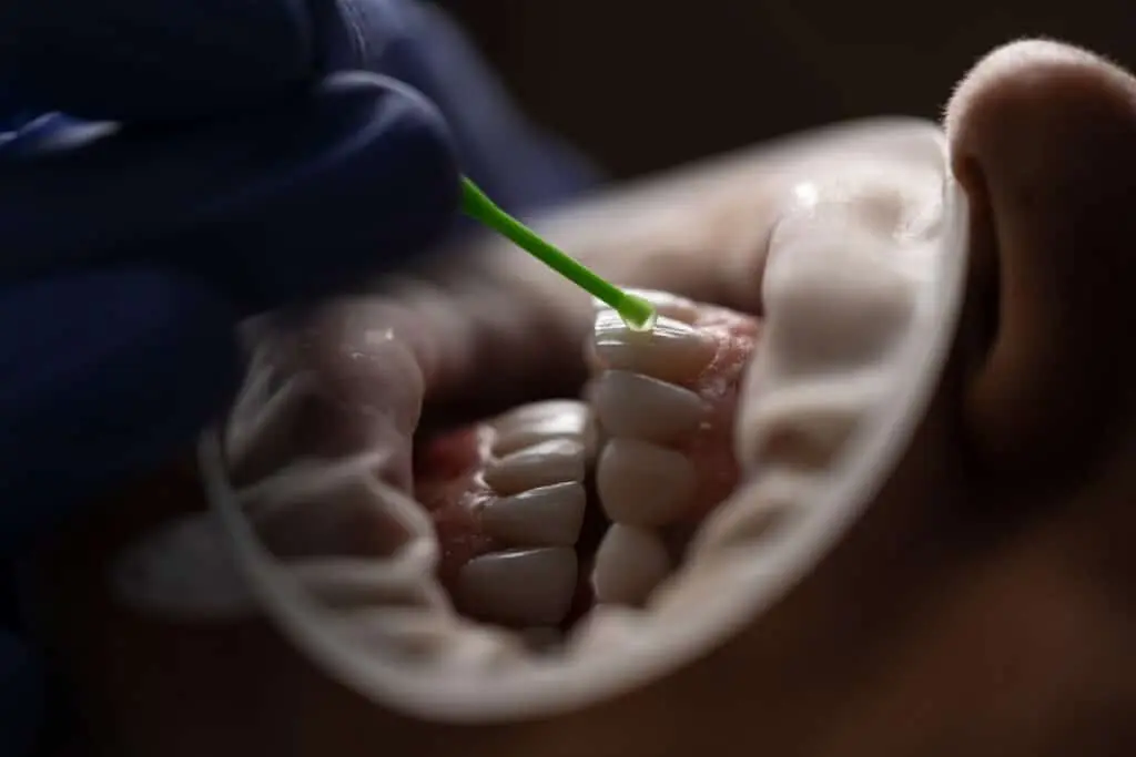 What is Tartar Dental Calculus 3 what is tartar3 1024x683 1