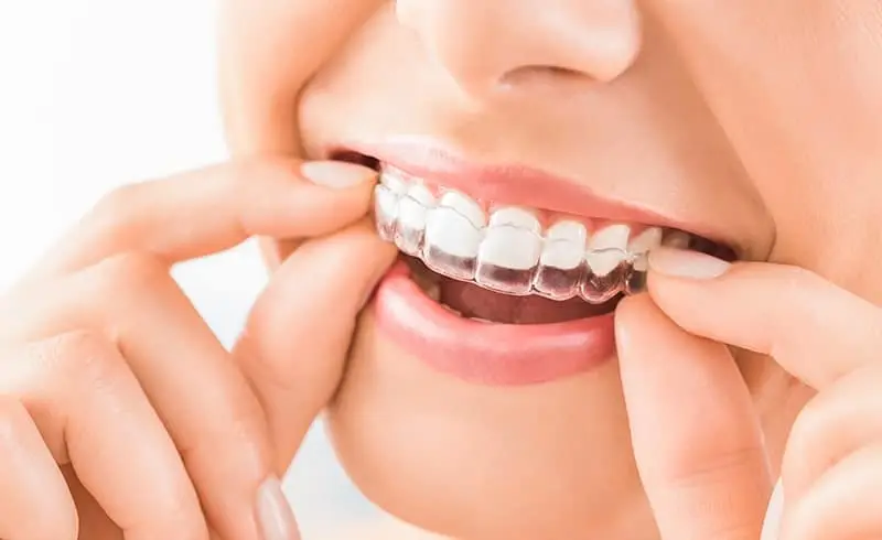 Am I Too Old for Invisalign 1 Patient inserting clear aligner over top teeth.