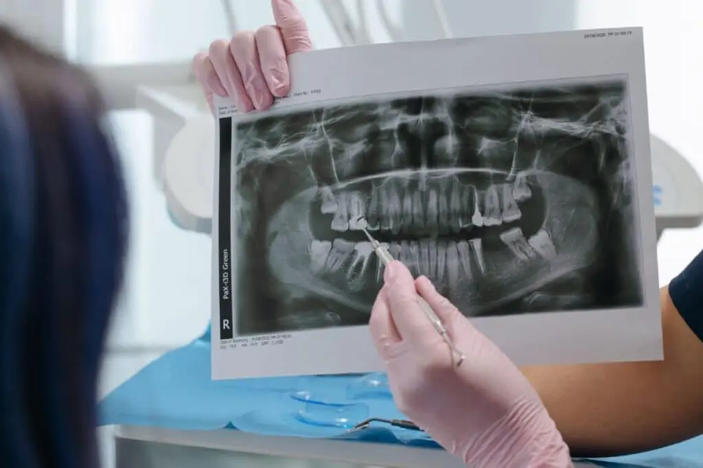 root canal retreament xray 1024x682 1
