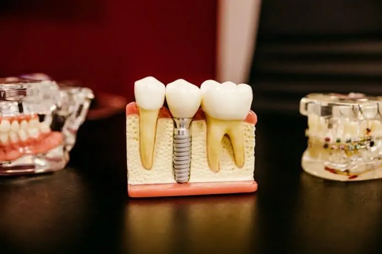 Dental implant model with prosthetic tooth crown above jawbone.