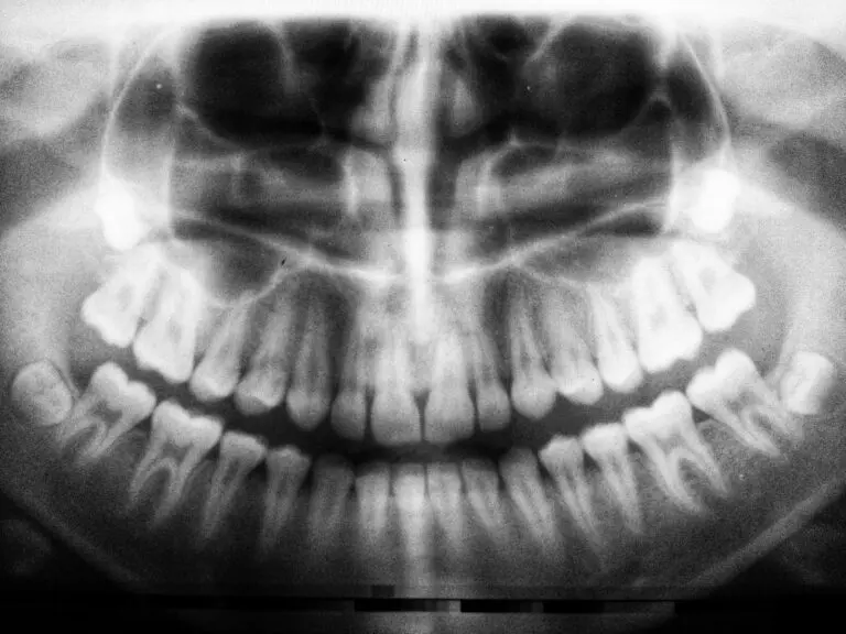 Step-by-Step Dental Filling Procedure 4 Panoramic dental X-ray image showing full mouth scan.