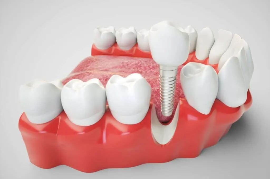 dental implant 3D rendering 1024x682 1