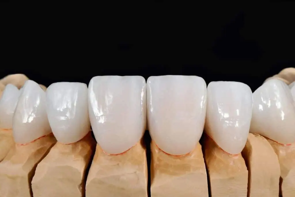 a sample of a temporary veneer 1024x682 1