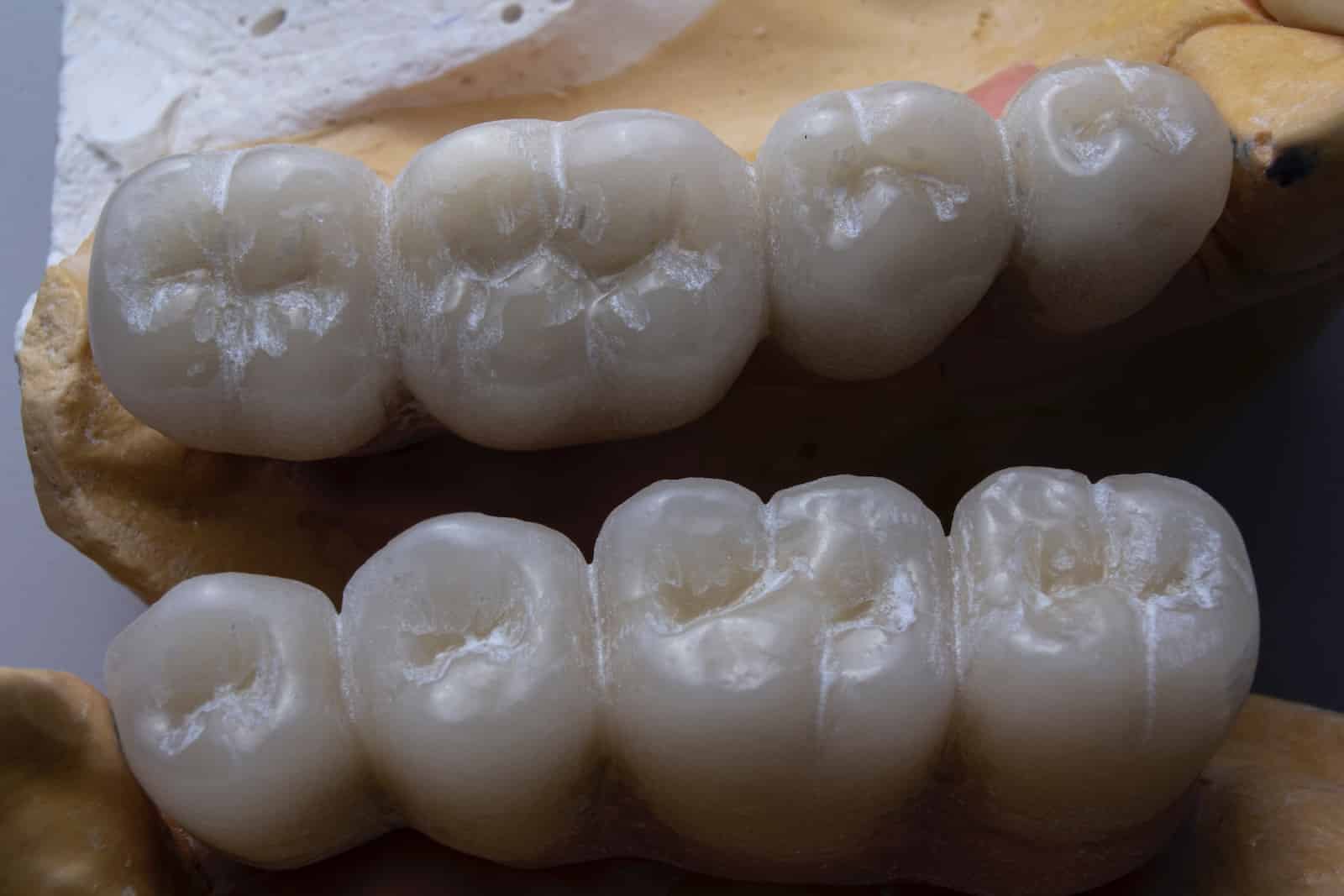 Bad breath after wisdom teeth removal: what to do 1 Close-up of dental crowns on molars with detailed grooves.