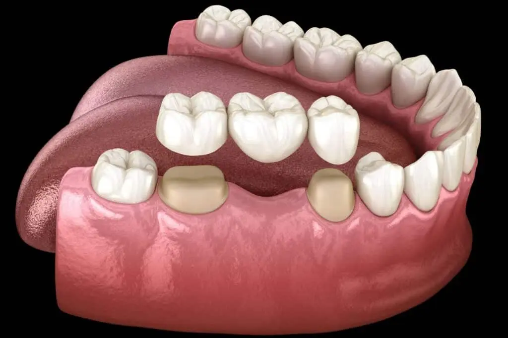 dental bridge 3D illustration 1024x682 1