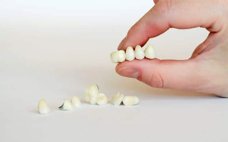 dental bridge