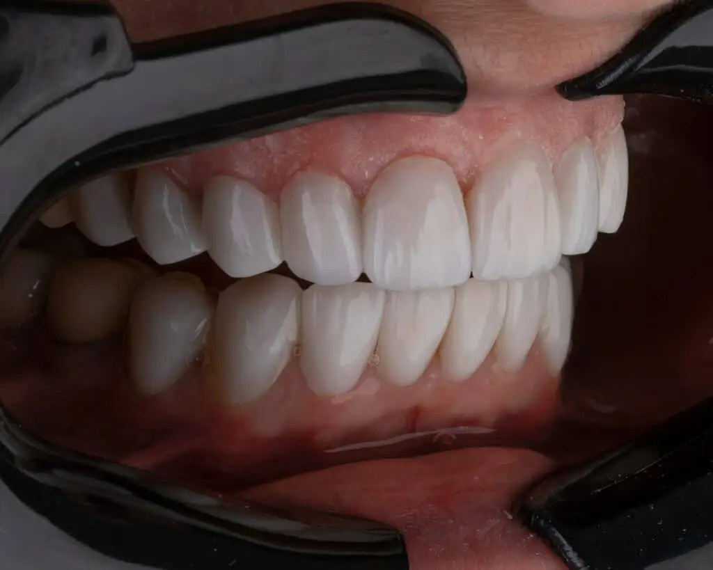 crowns on front teeth