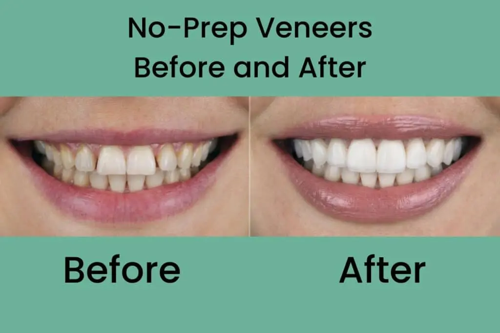 No Prep Veneers Before and After 1024x682 1