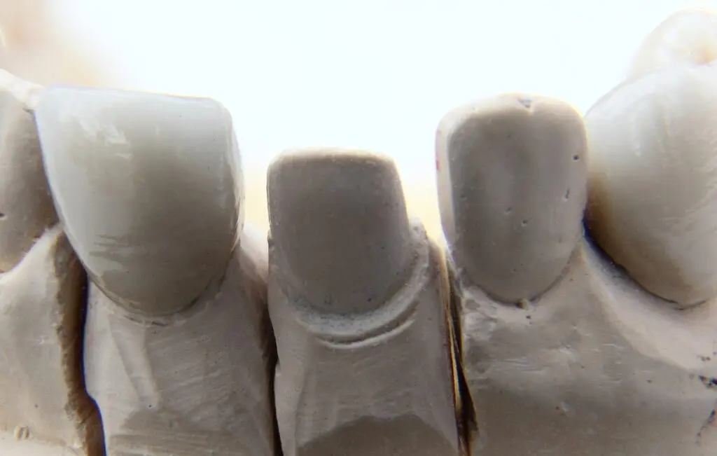 dental crown 1024x651 1