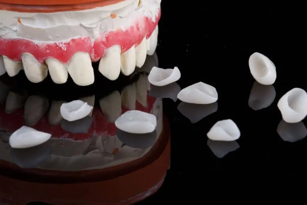 Different Types Of No Prep Veneers 1024x682 1