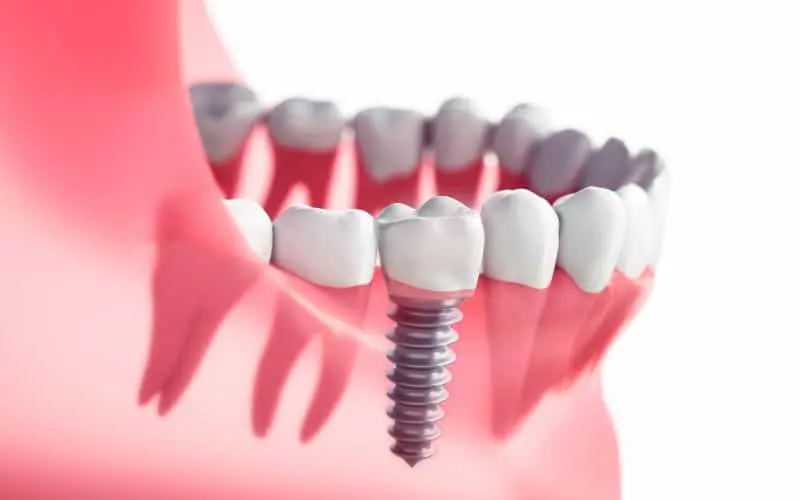 a close up illustration how do dental implants work