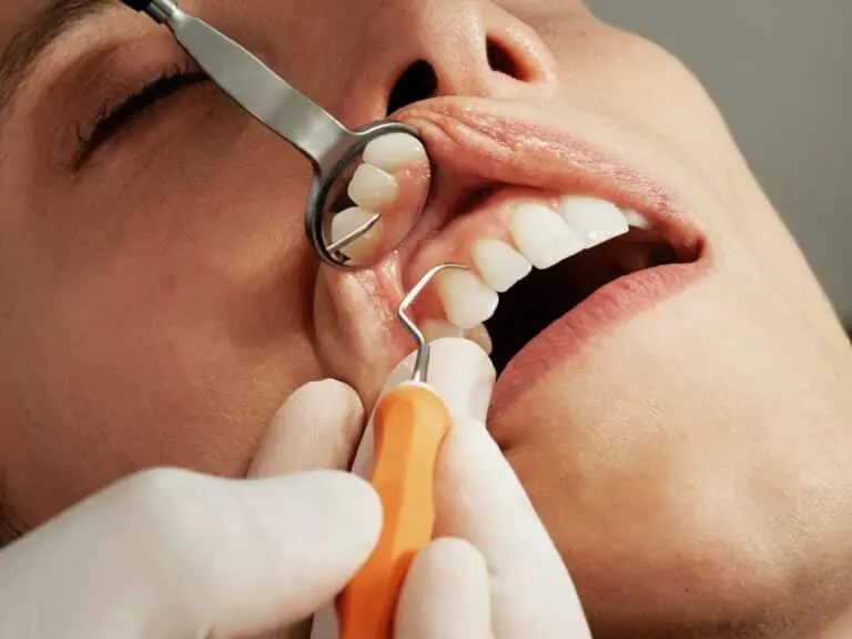 What is Tartar Dental Calculus 6 Close-up of dental scaling with mirror and curette tool.