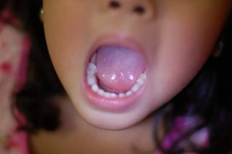 What are dental sealants? 1 Close-up of a child’s open mouth showing new teeth growth.