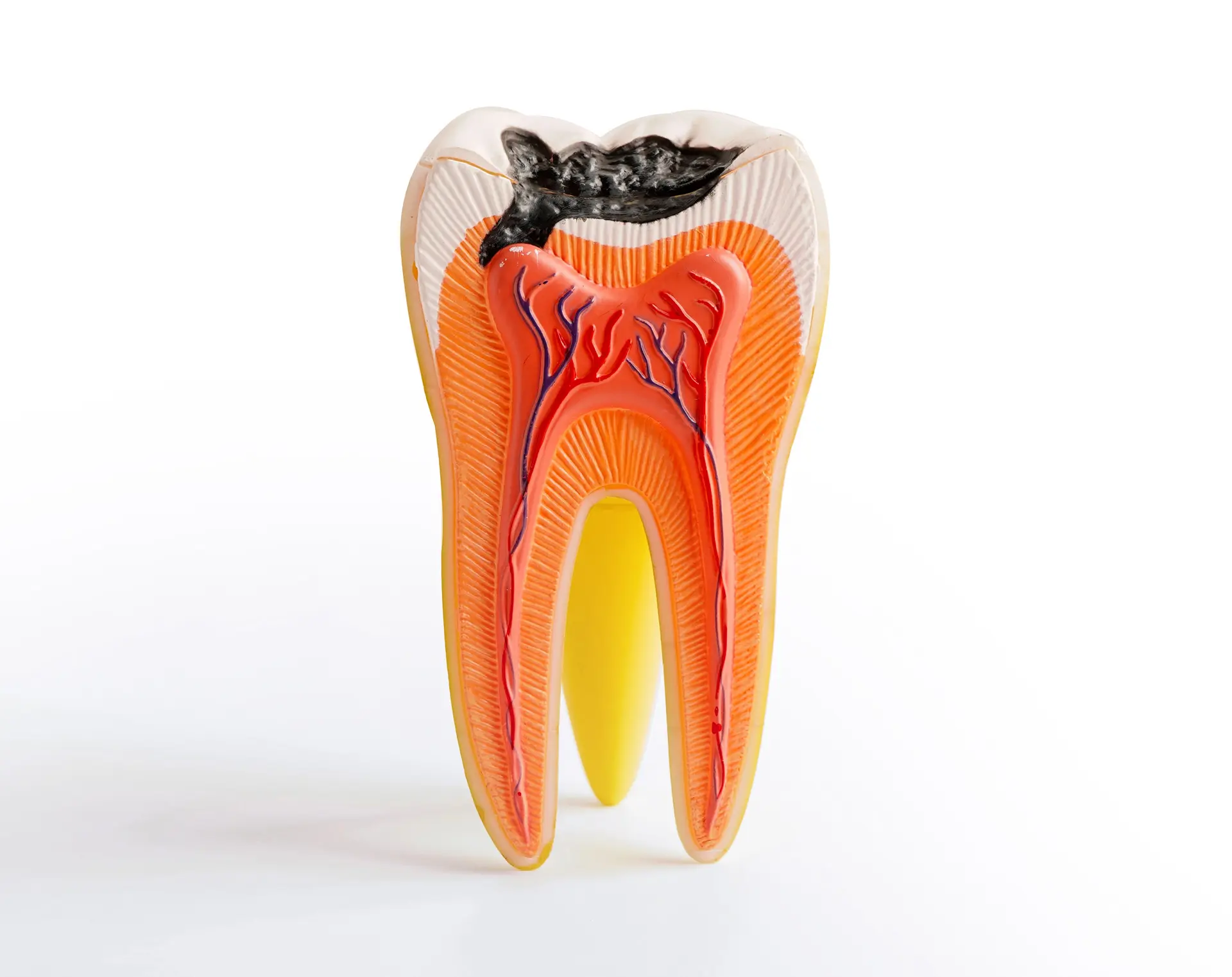 Root Canals 1 A detailed image of the inside of a tooth that has a cavity.