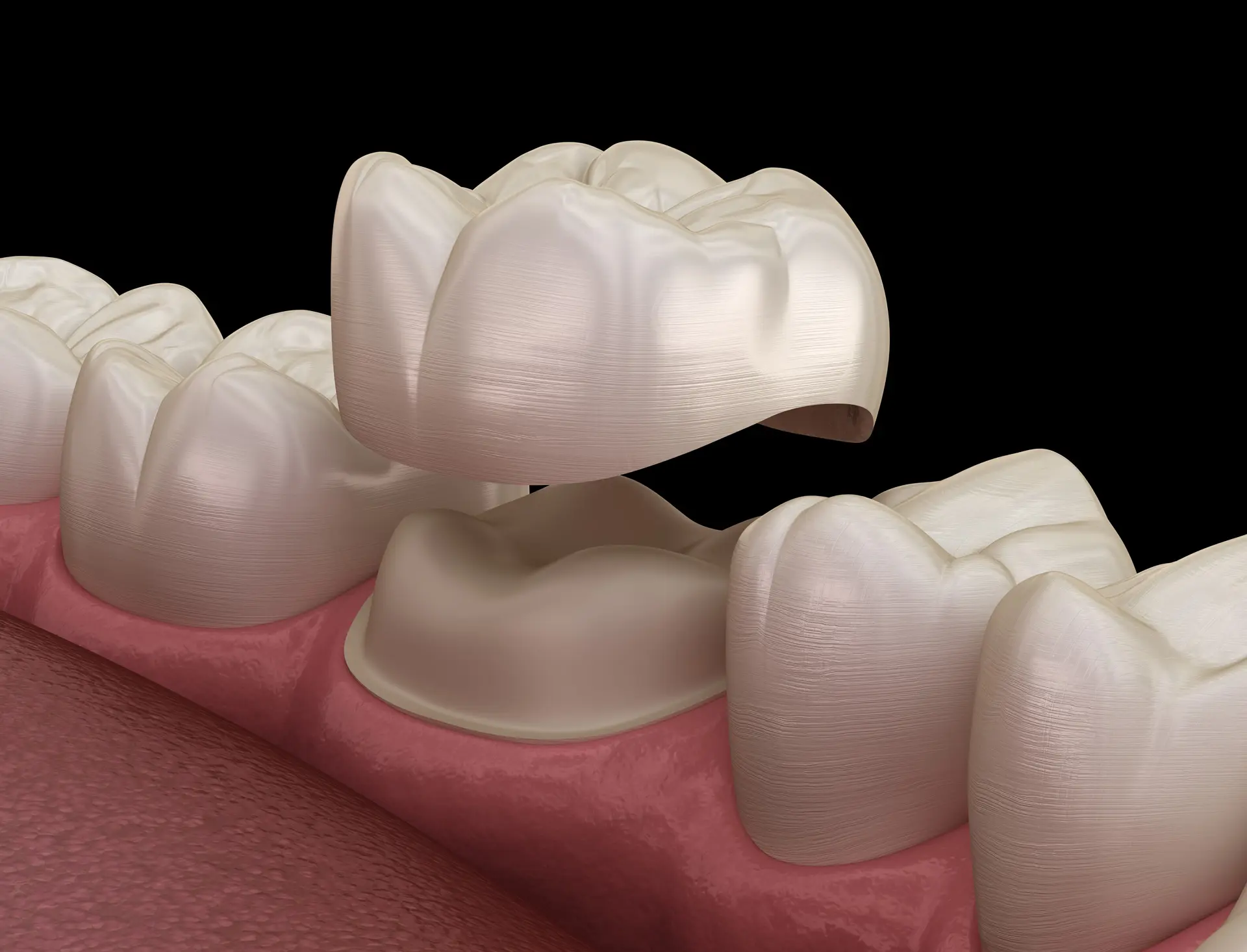 Dental Crowns 1 A dental crown being placed over a prepared tooth