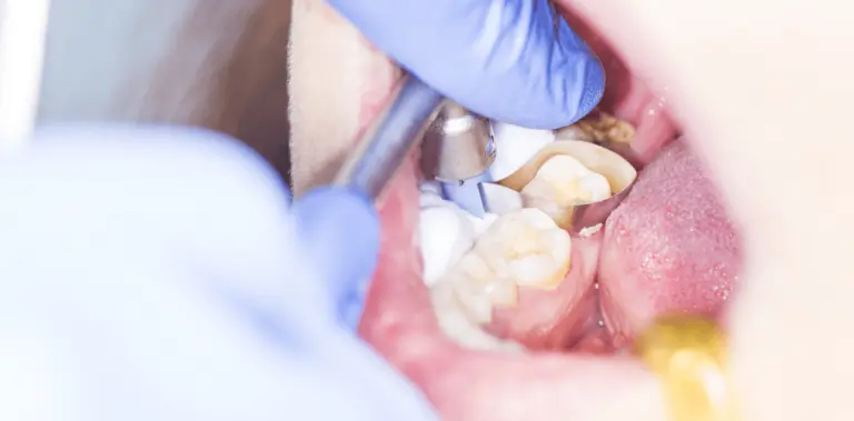What is Dental Bonding?