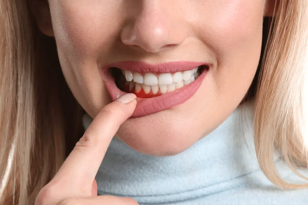 Perio Protect | VP Dental | Perio Protect in Raleigh A woman pulling down her lip to reveal red, inflamed gums
