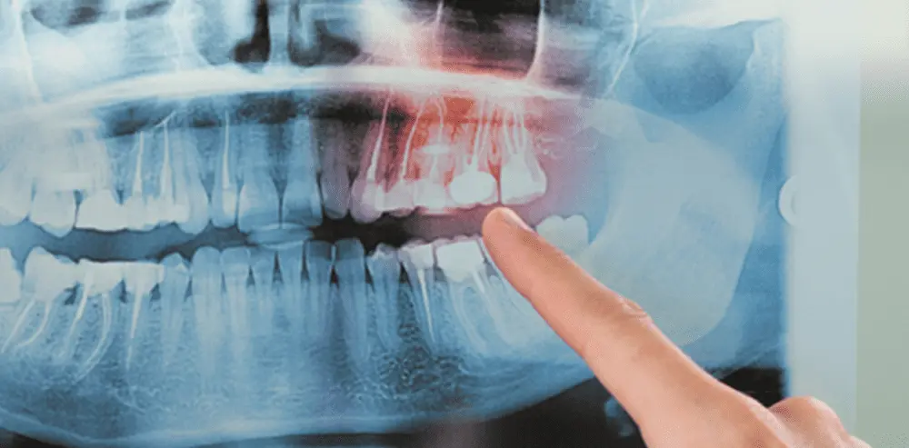 How Essential Oils and Your Dentist Can Treat Receding Gums | VP Dental | Treat Receding Gums VP Dental | Treat Receding Gums