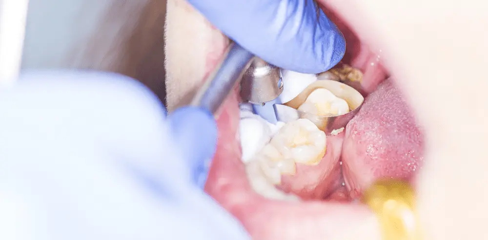 VP Dental | What is Dental Bonding