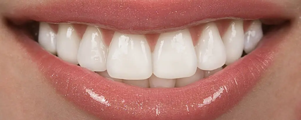 Enamel Shaping | VP Dental | Enamel Shaping in Raleigh Close-up of a person’s mouth after enamel shaping process