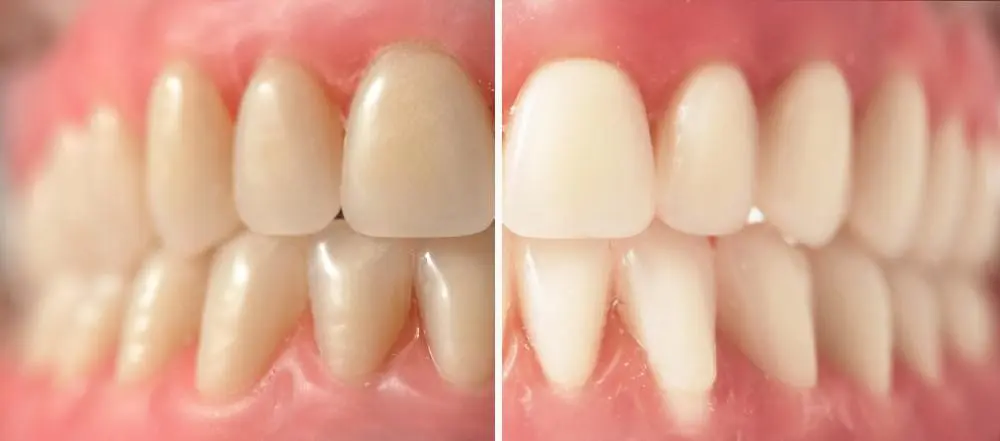Dangerous DIY Teeth Whitening Practices | VP Dental | Dangerous DIY Teeth Whitening Practices VP Dental | Dangerous DIY Teeth Whitening Practices