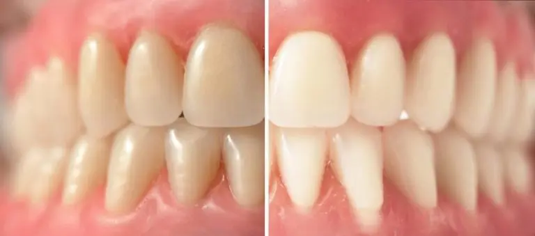 Results of our at home teeth whitening in Raleigh