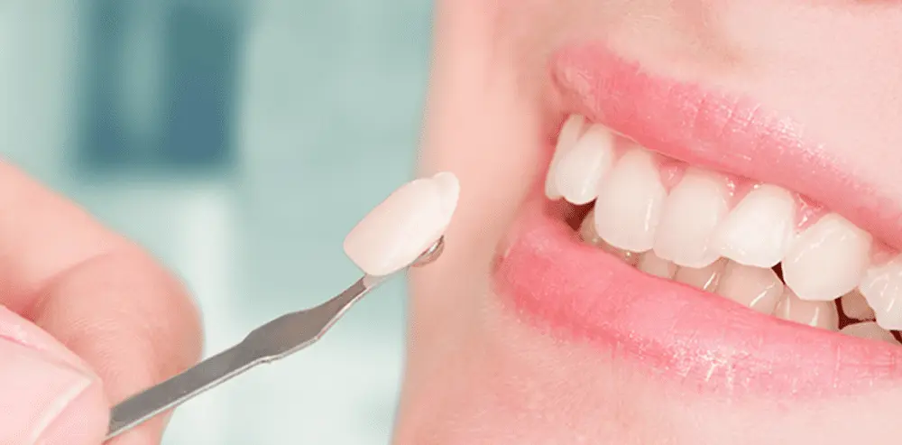 VP Dental | Dental Veneers