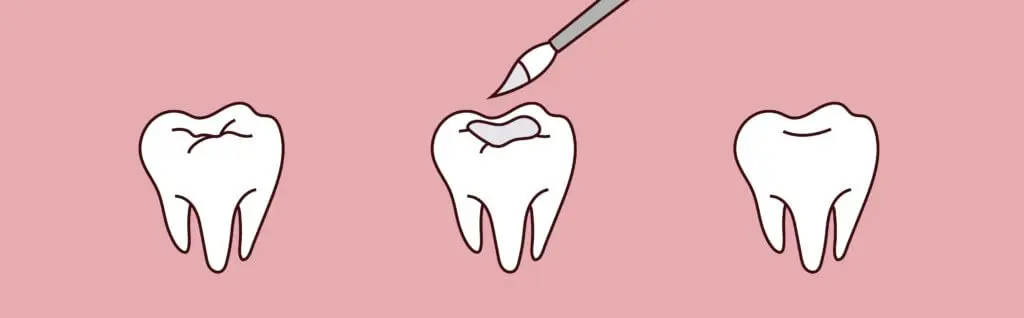 Illustration of a tooth being filled, showing the process from cavity to completion on a pink background