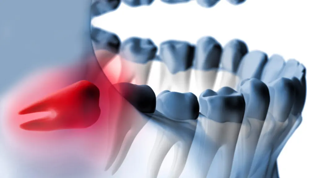 X-ray closeup of an impacted wisdom tooth