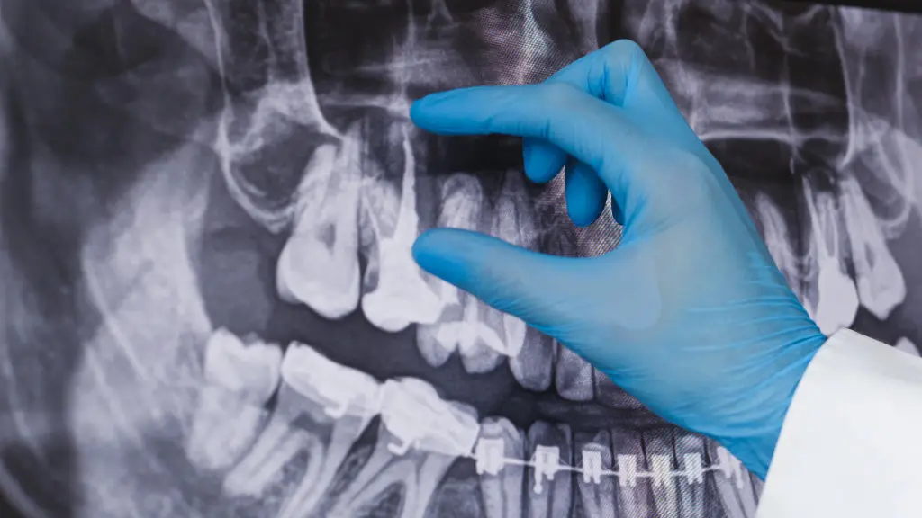 Dentist examining X-rays for root canal treatment