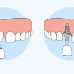 dental implants vs dental bridges