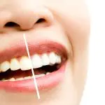 Teeth Whitening vs. Store-Bought Products