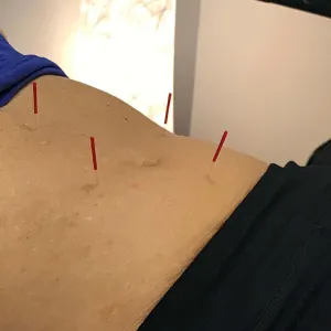 Acupuncture for Weight Loss in Somerset, NJ