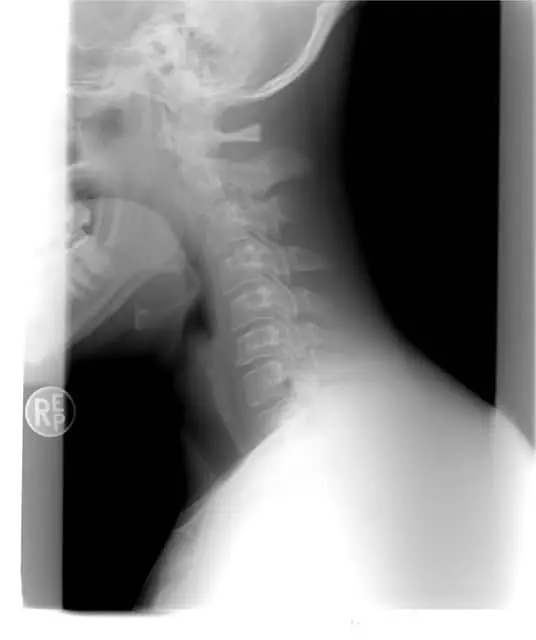 Pinched Nerve Diagnosis