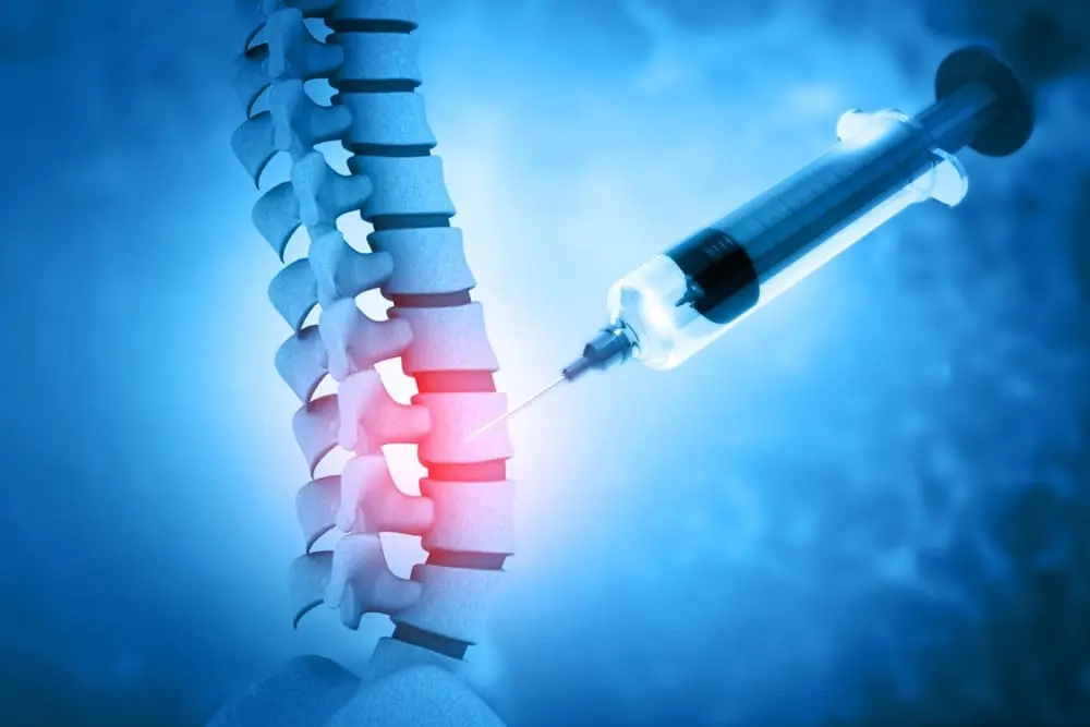 Lumbar Epidural Injections