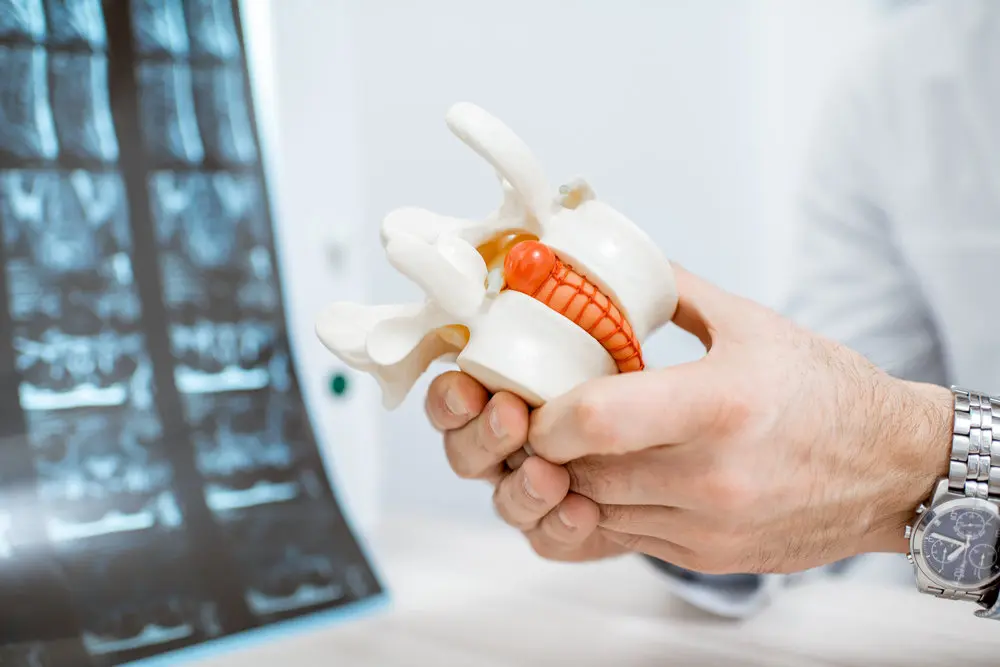 Primer plano de un terapeuta sosteniendo un modelo anatómico de vértebras con hernia intervertebral.
