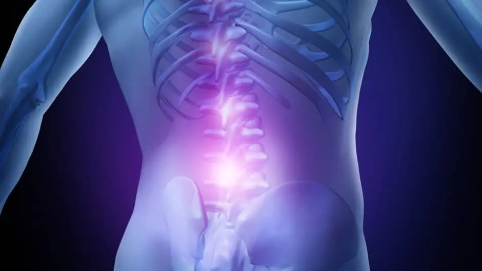 sciatica