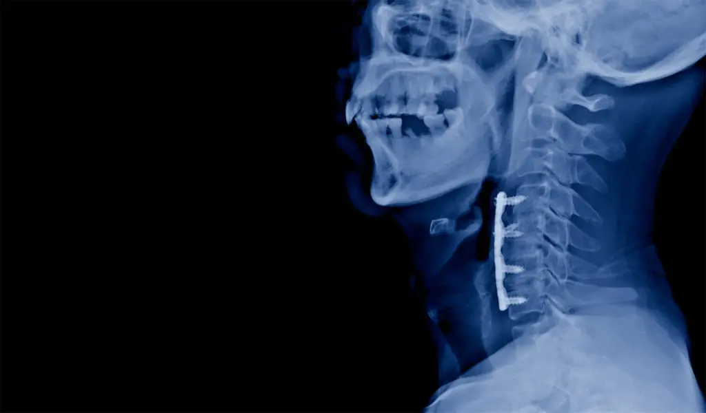 AdobeStock 544770663 - New York Spine Surgery