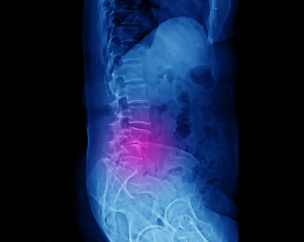 Spinal Fusion in New York